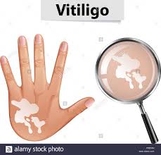 ducrest's tweet photo. #VitiligoAwarness - Antioxidant Supplements in Combination With Phototherapy for #Vitiligo https://t.co/GObHq96sr9; oral antioxidants may enhance responses to phototherapy, however trials with large sample sizes are warranted https://t.co/Soo3Foriw6
#dermatology #dermatologia https://t.co/01Kc6BRDta
