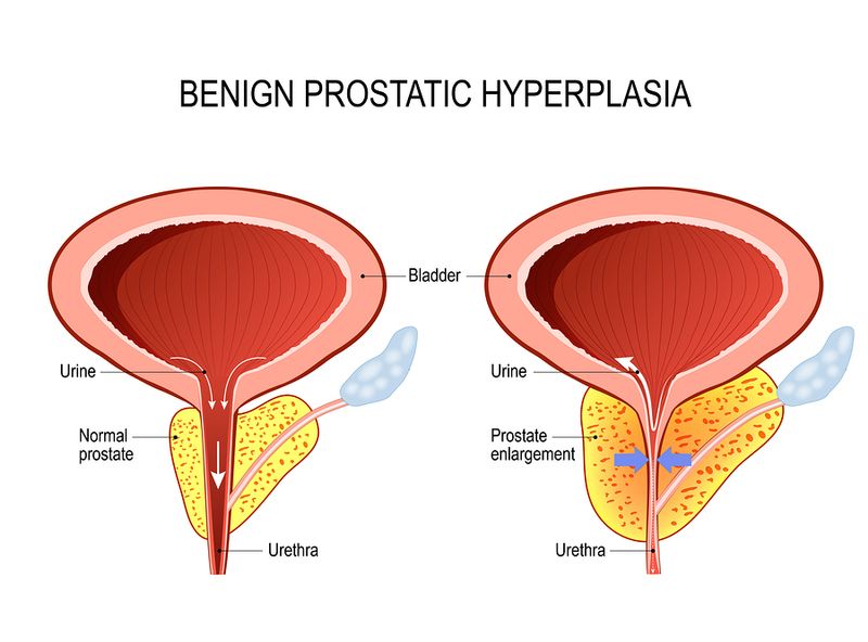 homéopathie prostate