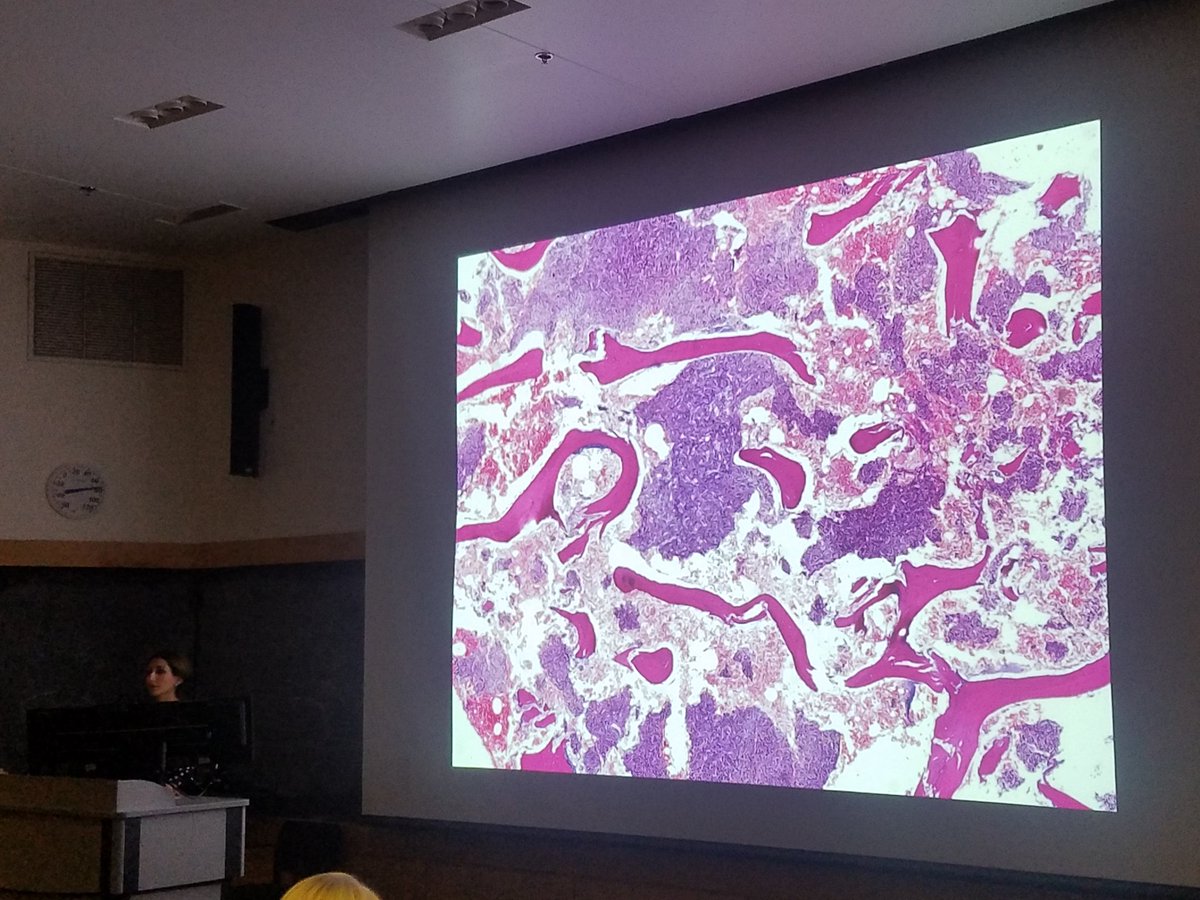 KMirza's tweet image. #Case6 by @koony84/@BorysdBorys was of a 24 year old woman at 16 weeks gestation with fatigue, lower back pain and left leg pain. Imaging revealed an ill-defined lesion in the left greater trochanter. Final diagnosis: Phosphaturic mesenchymal tumor