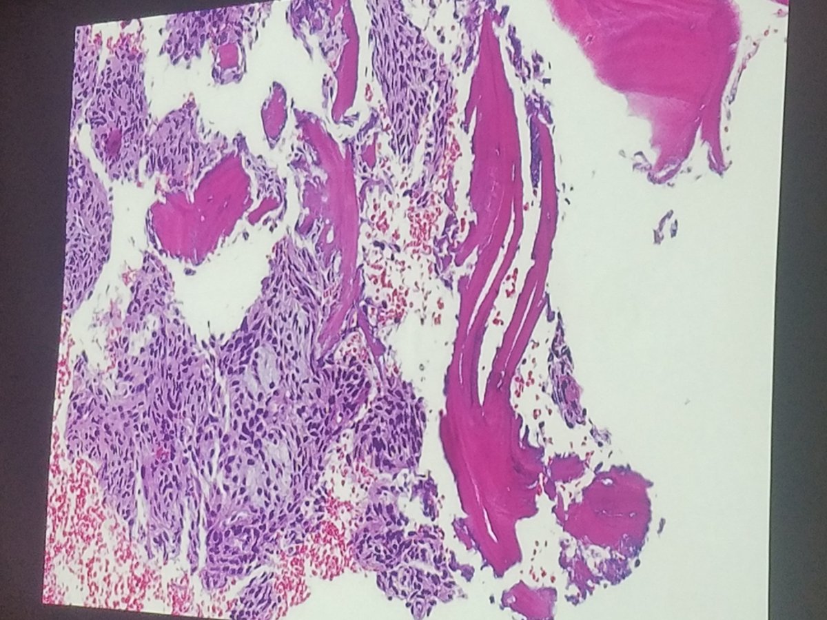 KMirza's tweet image. #Case6 by @koony84/@BorysdBorys was of a 24 year old woman at 16 weeks gestation with fatigue, lower back pain and left leg pain. Imaging revealed an ill-defined lesion in the left greater trochanter. Final diagnosis: Phosphaturic mesenchymal tumor