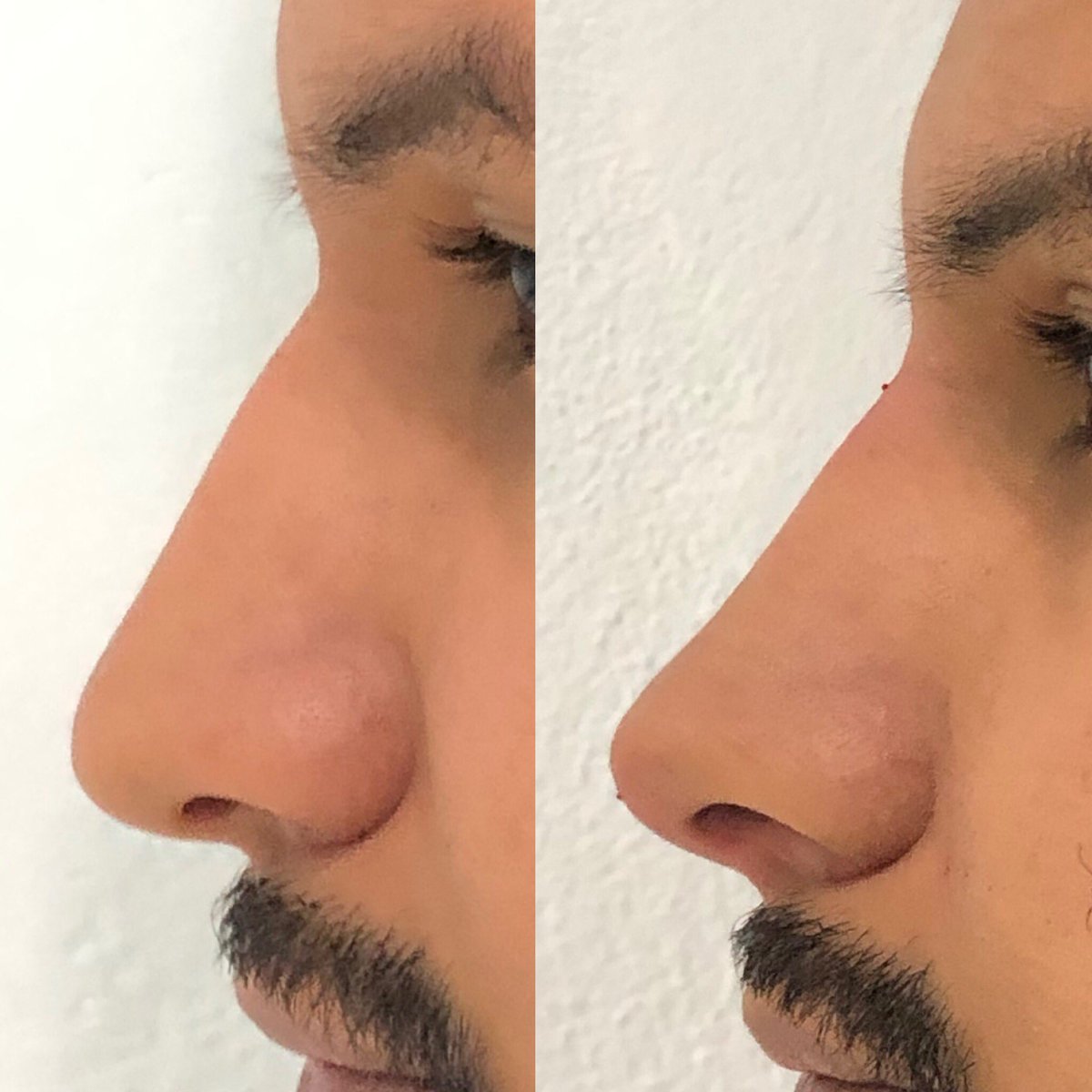 javierderma's tweet photo. #Rinomodelacion con ac hialuronico
Procedimiento médico realizado en 30 min en consultorio
@Dermedica
.
#achialuronico #restylane https://t.co/3GcHXfoObl