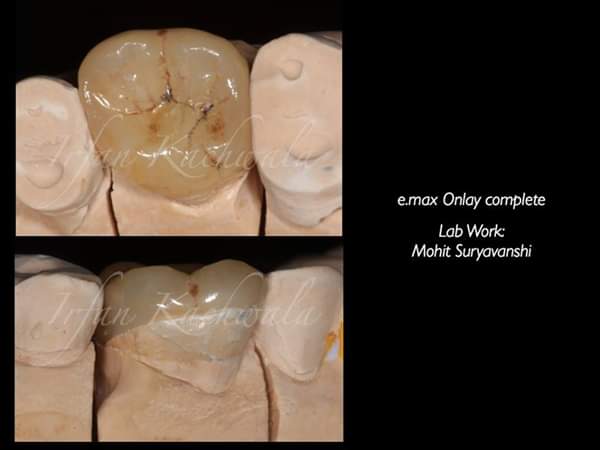Listen to Dr. Irfan Kachwala Preconference Speak on " Posterior bonded restorations " at ICD 2018 during 14th December - 16th December at Hyderabad, India.
icdconference.com/archives/speak…
Register Online@ icdconference.com/online-registr…

#ICDConference2018 #ICDConference #DrIrfanKachwala