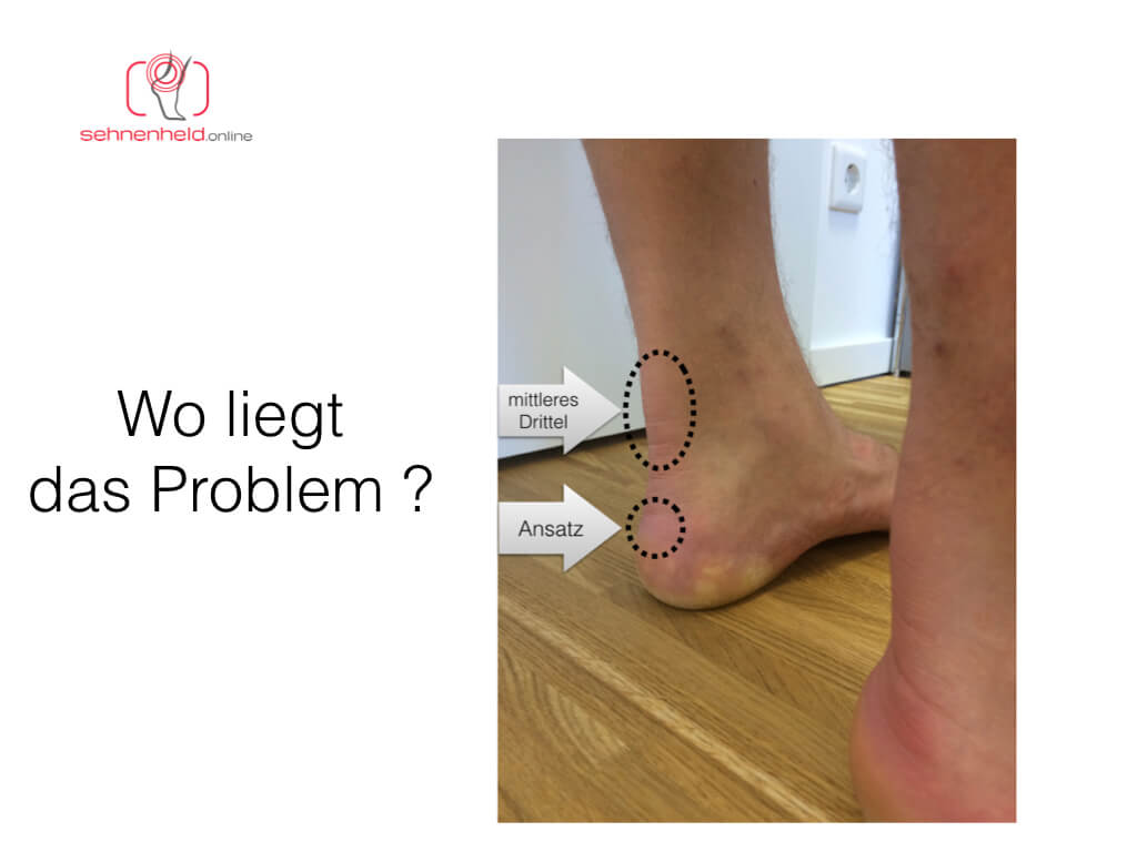 Wenn Du Achillessehnenprobleme hast: #Achillodynie keine Diagnose und keine Basis für eine sinnvolle Behandlung chmp.ly/48o