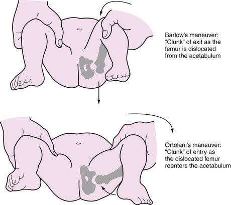 أرشدني التمريض Na Twitteru Addition To Visual Clues The Doctor Will Perform Physical Examination To Listening Feeling Clunks As Hip Is Put In Different Positions Useing Specific Maneuvers To Determine If Hip Can