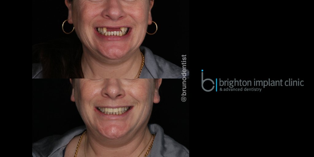 Dentalimplants8's tweet image. Restoring #missingfrontteeth with #dentalimplants. This was a true team effort from everyone at our clinic, dental nurses, dentists, dental technicians and other team members. In this case two dental implants supporting four front teeth. What a great feeling to start the week!