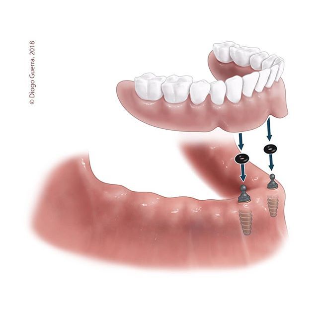 O-Ring Abutment (KKA) | K3Pro implant