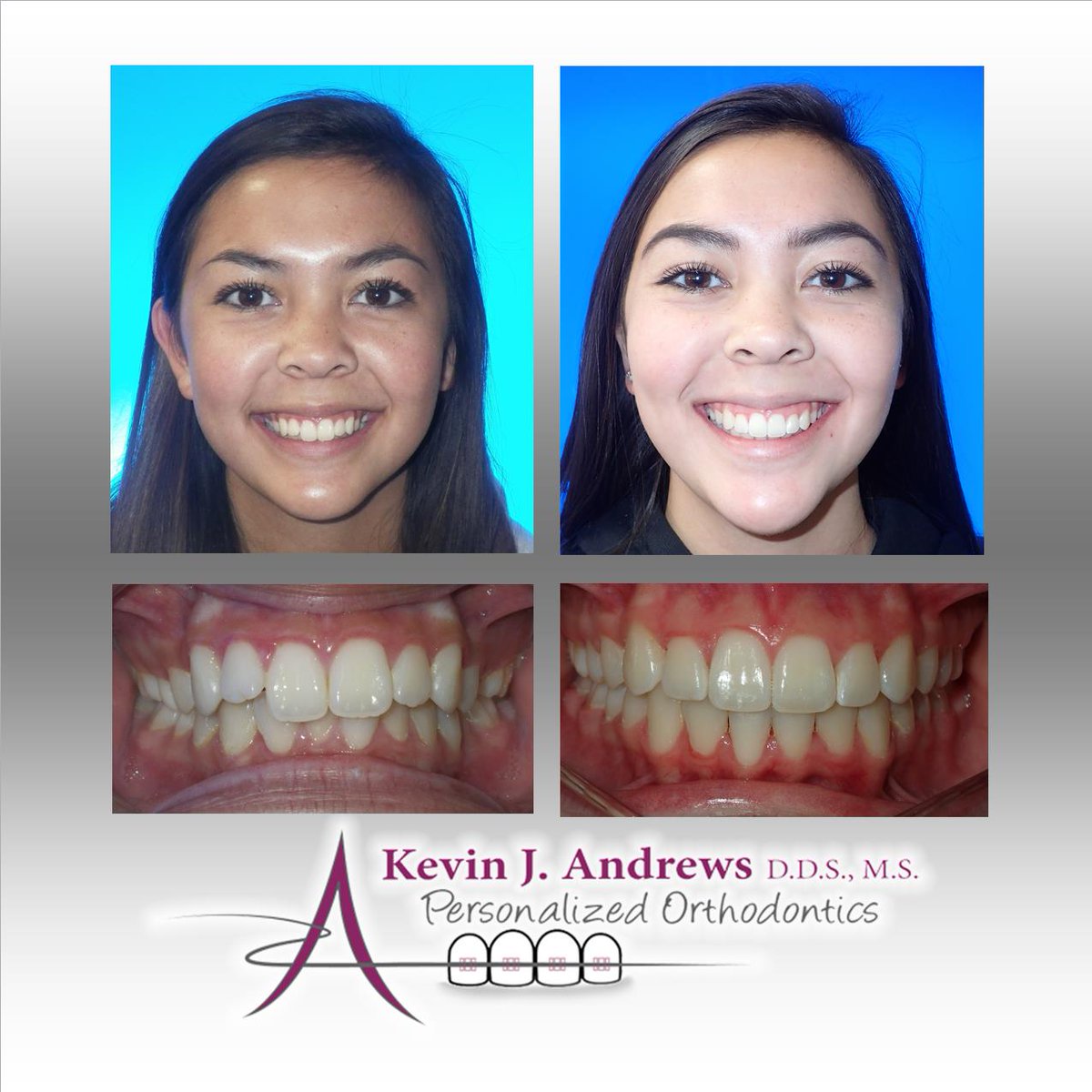 AndrewsBraces's tweet photo. Congratulations Cami! Your smile is stunning! #AndrewsBraces #NewSmile #LoveToSmile #InstaPic #Me #NoFilter #WePutOurHeartIntoYourSmile #Reno https://t.co/lyMYlCkce8