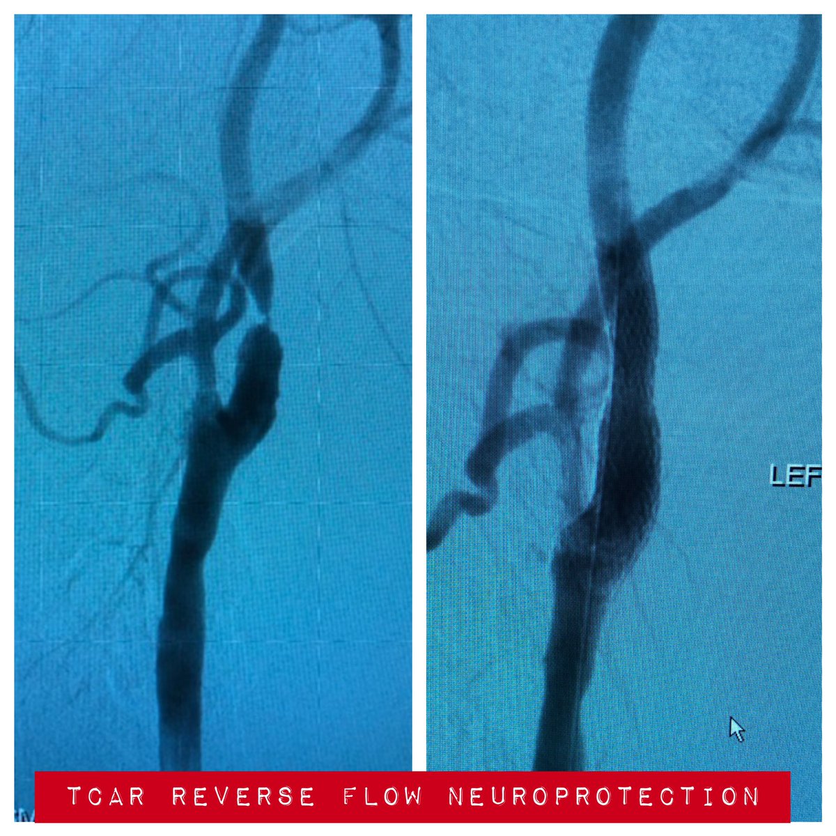 julesMD84's tweet photo. #TCAR in symptomatic carotid with bilateral tight stenoses and surgically inaccessible lesions (C1-2 bilaterally). Thanks @SilkRoadMed! #flowreversal #carotidstent https://t.co/ZtBCCqKmRO