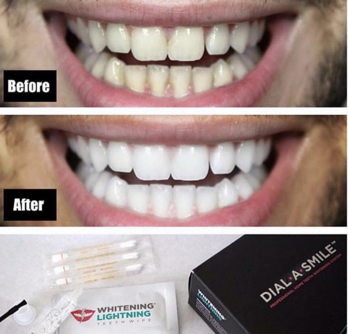 WhiteningLtning's tweet photo. These results donβt lie π Dial A Smile gives you a white grin in just 20 minutes! Use code CUPID for 50% off your entire order #teethwhitening #whiteninglightning #dialasmile @salihsworld https://t.co/dUMkfb7Hei