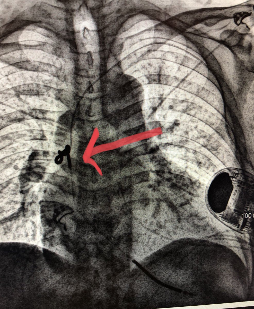 drdavidsingh's tweet photo. Anyone every seen svc coil coiling from twiddlers?  Any other explanations for this finding? https://t.co/Px0CJnph65