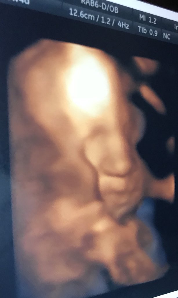 Drose__'s tweet photo. She finally gave us a little look ๐น๐#THEroguebaby #Scarlettrose #divainthemaking #destinyschild #cheerbaby #4dultrasound https://t.co/W4bJisa80r