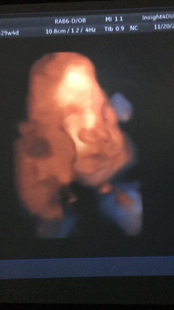 Drose__'s tweet photo. She finally gave us a little look ๐น๐#THEroguebaby #Scarlettrose #divainthemaking #destinyschild #cheerbaby #4dultrasound https://t.co/W4bJisa80r