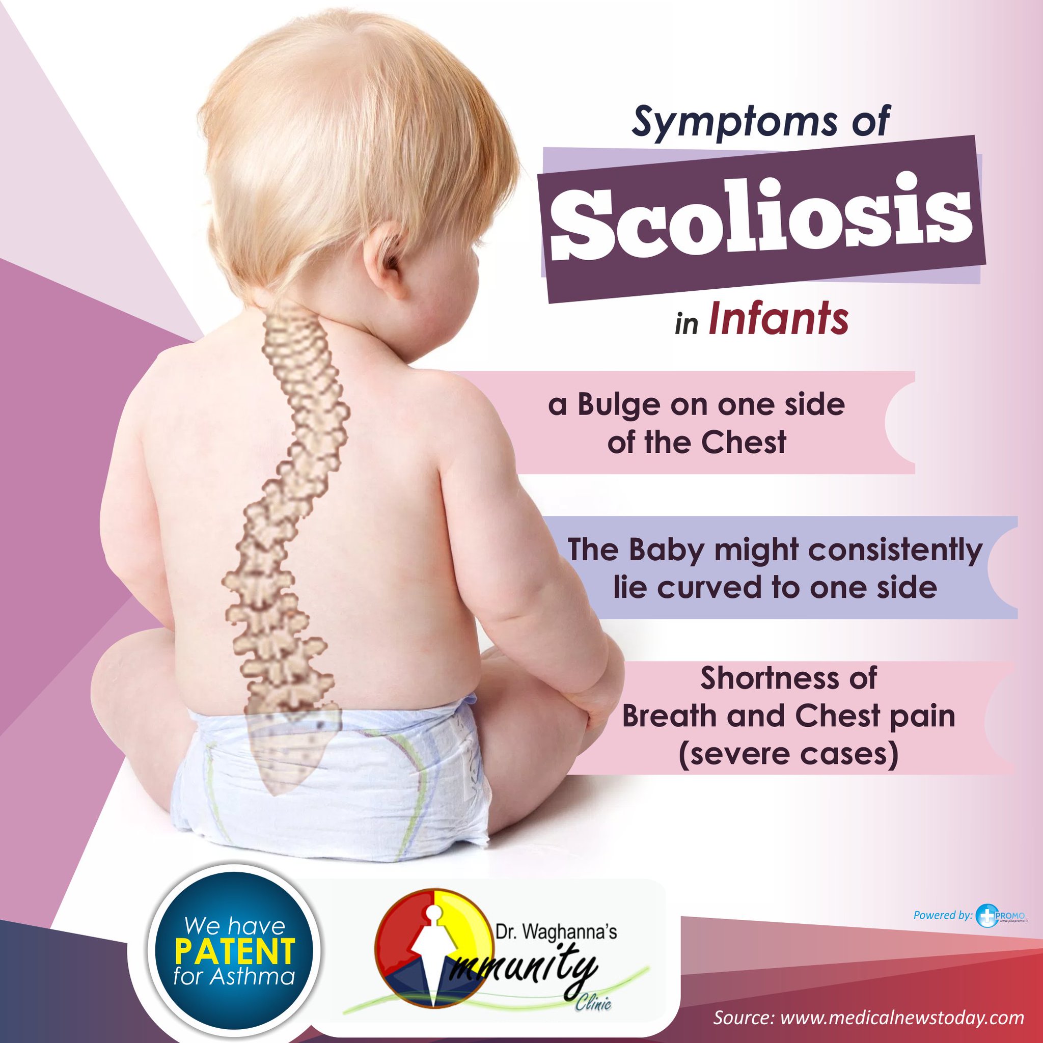 Symptoms scoliosis