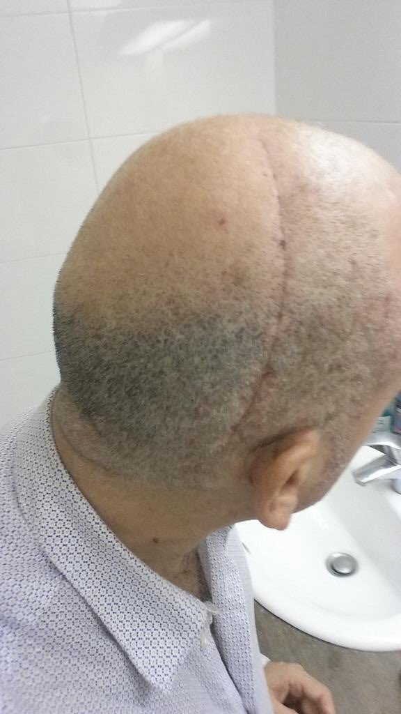 EnModeMacaron's tweet photo. UNE PHOTO CHOC!

Voilà à quoi ressemblait le crâne de Boris Faure après sa terrible agression par le député M’jid El Guerrab!

Cet homme a été élu sous l’étiquette LREM et refuse de quitter son poste!

IMPOSSIBLE D’ACCEPTER ÇA!

👉RT pour qu’il soit forcé à quitter l’Assemblée! https://t.co/rT3SMed4mf