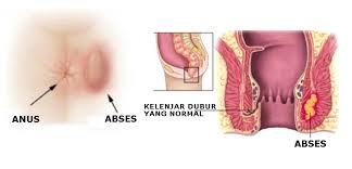 Pengobatan Denature En Twitter Beberapa Penyebab Muncul Benjolan Di Samping Lubang Anus Https T Co Qtalkibwsw Https T Co Kvgqxwqlna Twitter