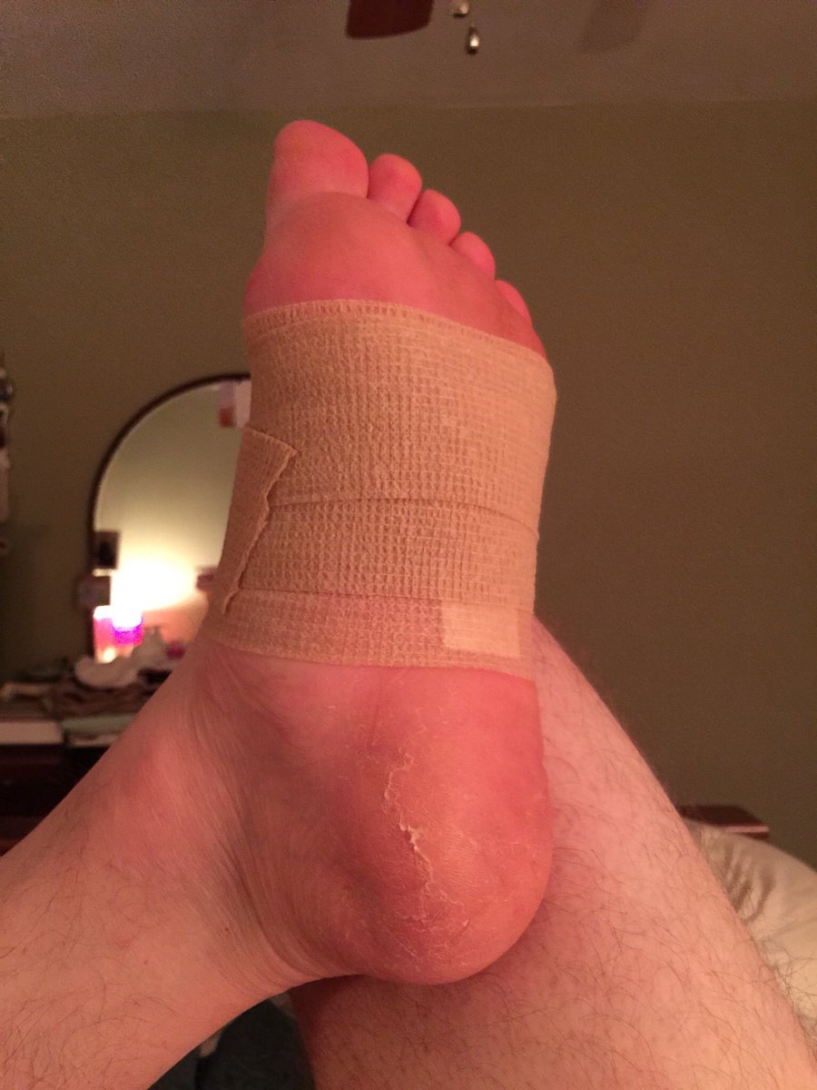 TimothyShell's tweet image. Jumping in the lake and impaling your foot on some random stake on the bottom. #ThingsBetterThanMichigan