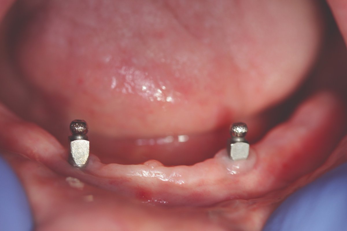 Find out about the restorative aspects of oral cancer reconstruction! go.nature.com/2AcGZ5o #MouthCancerAction <a href="/dentalhealthorg/">Oral Health Foundation</a>