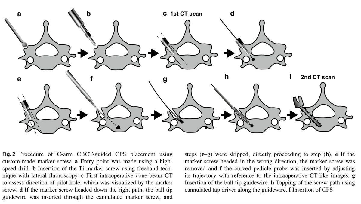 EurSpineJournal's tweet photo. In the November issue of ESJ a novel technique of #cervical_pedicle_screw placement with a pilot screw under the guidance of intraoperative #3Dimaging from #C_arm cone‐beam CT without navigation.
https://t.co/676OtvQEVq https://t.co/MvNbzRNsas