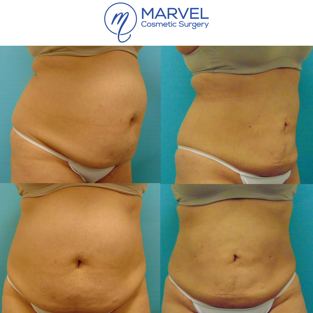 MarvelCosmetic's tweet photo. You can achieve AMAZING results with SlimLipo. Not only can this procedure blast away fat, but it has the unique benefit of tightening your skin! Learn more about SlimLipo by contacting our offices at 615-329-3900 today! https://t.co/08kFyXLFku