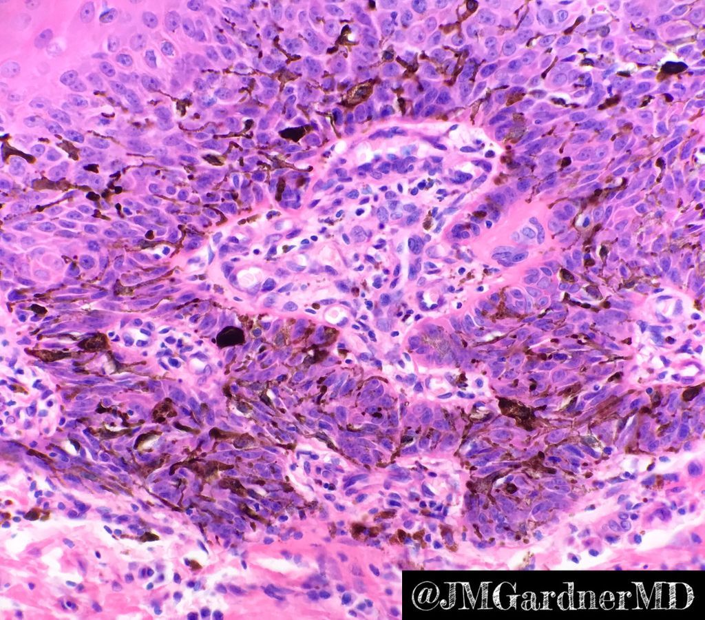Inverted follicular keratosis with a bonus: BIG scattered pigmented dendritic melanocytes! They’re just “passengers” along for the ride. Not melanoma. Evenly spread out in the keratinocytic lesion. Can see these in BCC, SCC, SK, adnexal, etc. #dermpath #Pathology #dermatology
