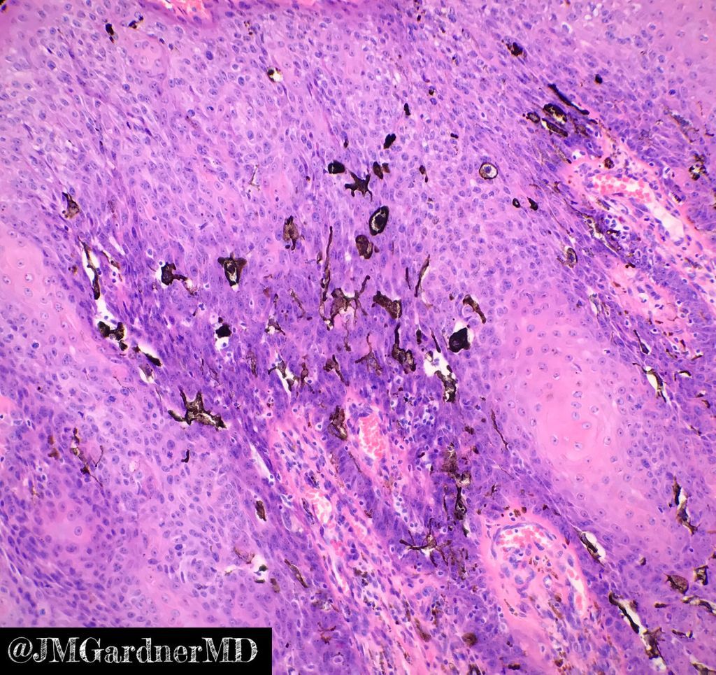 Mature cystic teratoma of the pancreas