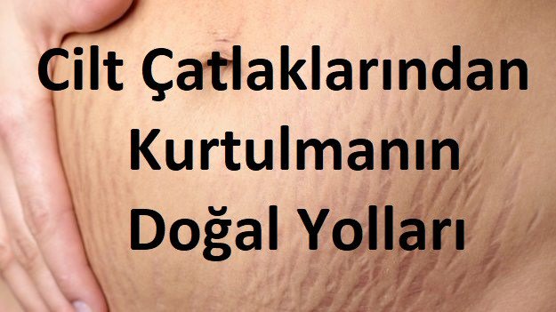 Cilt Çatlaklarından Kurtulmanın Doğal Yolları keyiflimutfak.net/cilt-catlaklar…