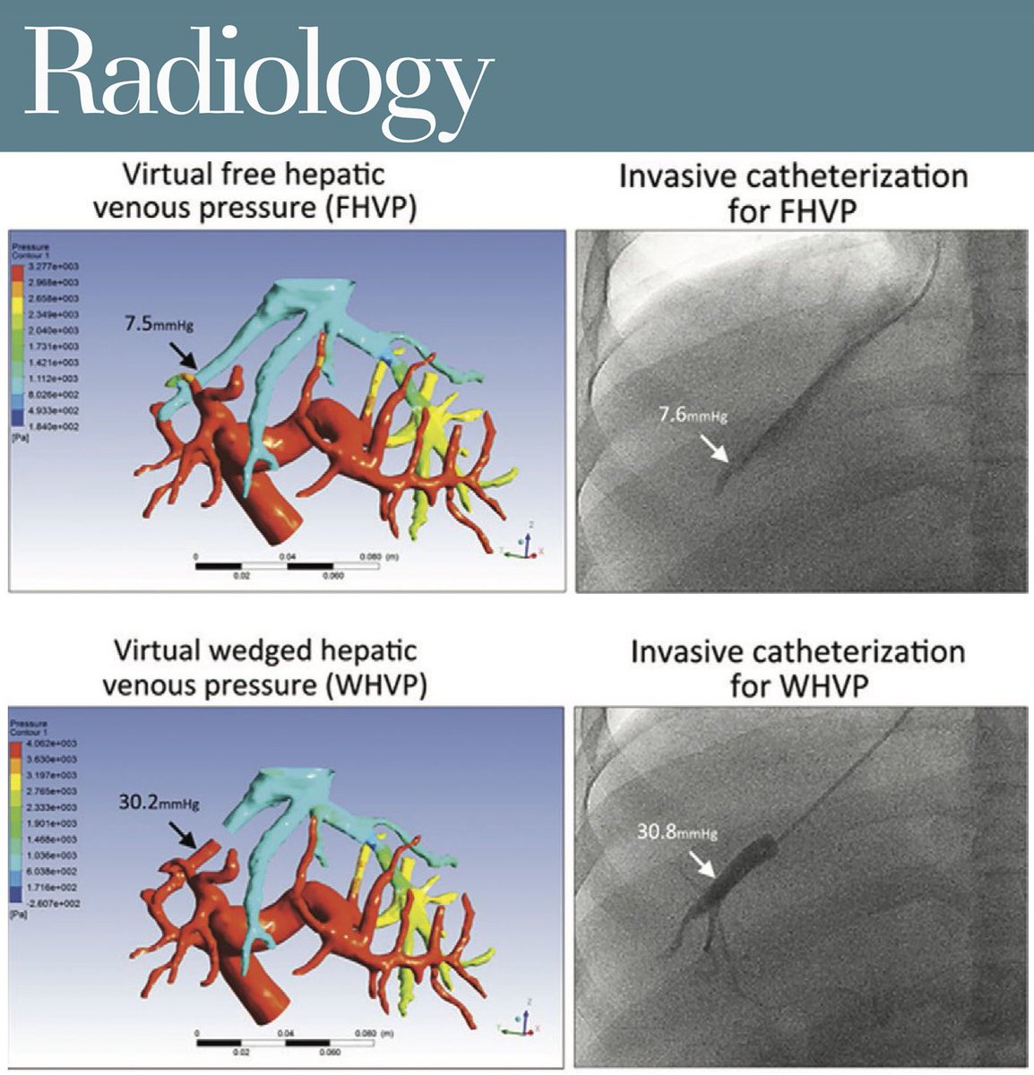 Xiaolong Qi (@xiaolong_qi) on Twitter photo Happy to share our CHESS1601 trial <a href="/Radiology/">Masters in Briyani</a>
Virtual Hepatic Venous Pressure Gradient with CT Angiography (CHESS 1601): A Prospective Multicenter Study for the Noninvasive Diagnosis of Portal Hypertension | Radiology pubs.rsna.org/doi/10.1148/ra… Happy to share our CHESS1601 trial <a href="/Radiology/">Masters in Briyani</a>
Virtual Hepatic Venous Pressure Gradient with CT Angiography (CHESS 1601): A Prospective Multicenter Study for the Noninvasive Diagnosis of Portal Hypertension | Radiology pubs.rsna.org/doi/10.1148/ra…