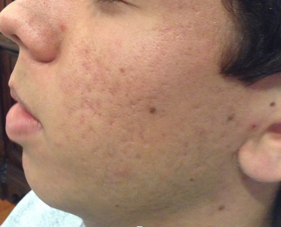 SkinHappyMD's tweet photo. Did you know that acne develops when hair follicles in our skin become clogged with sebum (skin’s oil) and dead skin cells, which together form the acne “plug”?  This plug can lead to an overgrowth of bacteria and excessive inflammation within the hair follicle. #skinhappymd https://t.co/k3IP1oki9c