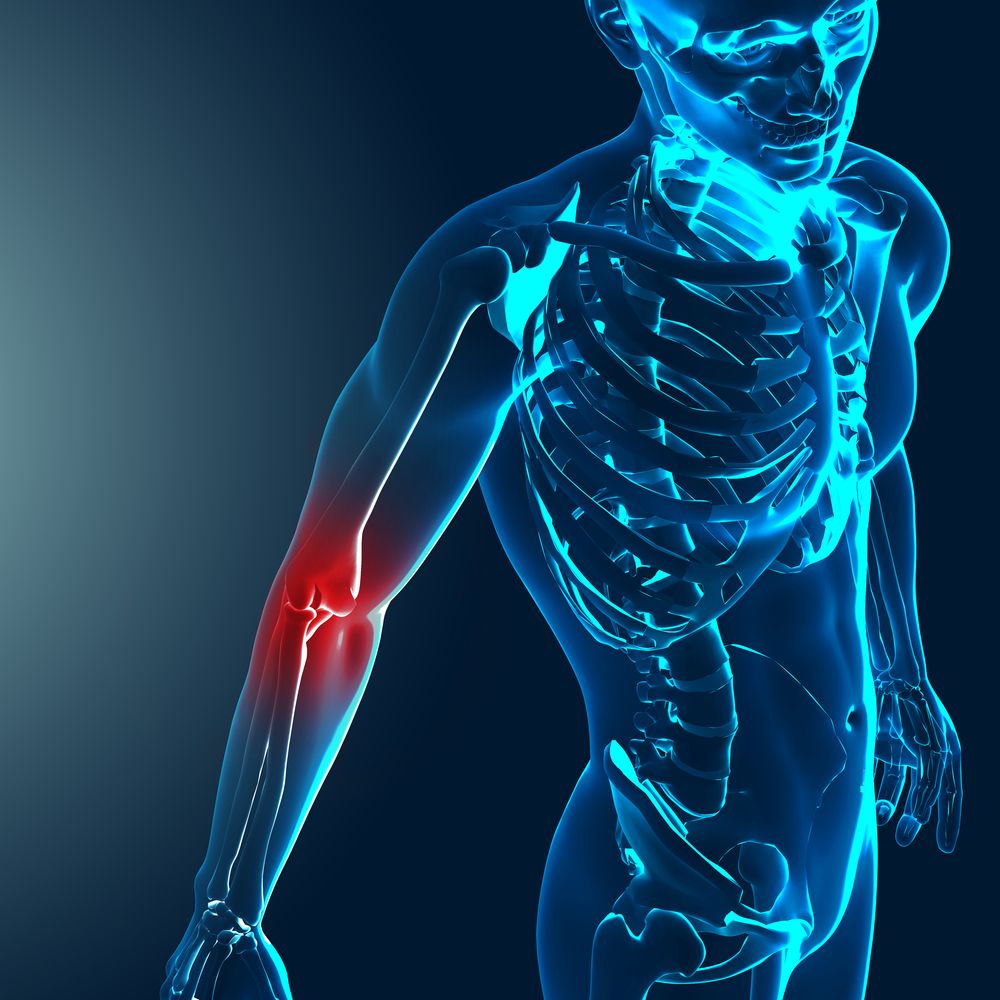 MillettMD's tweet photo. A #distalbiceps #tendon rupture is an #injury that occurs at the #elbow joint. It most commonly affects middle-aged men and is caused by heavy lifting or #sports. https://t.co/M8uT90pMxH https://t.co/CboxNT5mAi