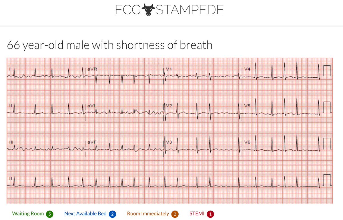 sandnsurf's tweet photo. Try out https://t.co/Q9tzTD7VfE

An exercise in ECG interpretation and triage. Review the 10 ECGs presented to you and assess their acuity. Decide:
1 STEMI; 2 immediately to be seen; 2 - next bed; 5 stay in WR

More than 320 ECG in the collection! https://t.co/AzBNOFH5wX