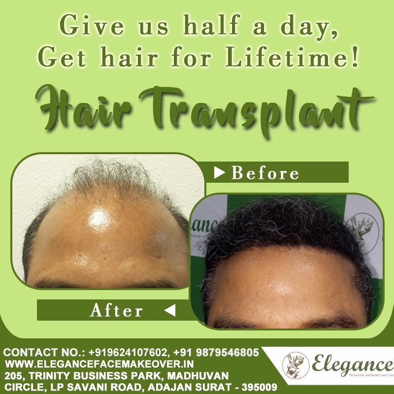 Best Hair Transplant for Men in Surat Gujarat India