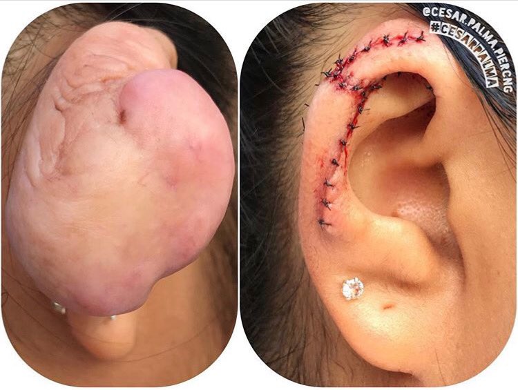 CPalmaPiercing's tweet photo. PERFÓRATE CON CUALQUIERA DECÍAN, NO PASA NADA DECIAN....
¡¡Recuerden que lo barato sale caro!!
Para ver este y muchos más de mis trabajos recuerden seguirme en mi cuenta de instagram
"Cesar.palma.piercing"
#keloid #keloids #keloidremoval #remociondequeloide #bodmod #bodmods https://t.co/IwnwgHRPkP