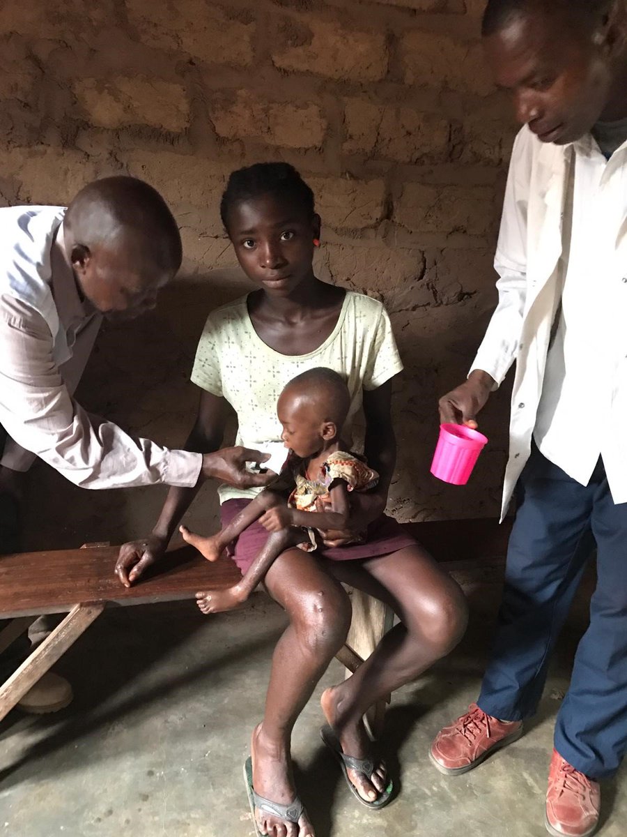 Uk In Drc En Twitter Kananga Bebe Paulina A Ete Diagnostiquee De Mal Nutrition Severe Et Aigue Apres 2 Semaines Au Sein D Une Unite Nutritionnelle Soutenue Par Ukindrc Et Unicef