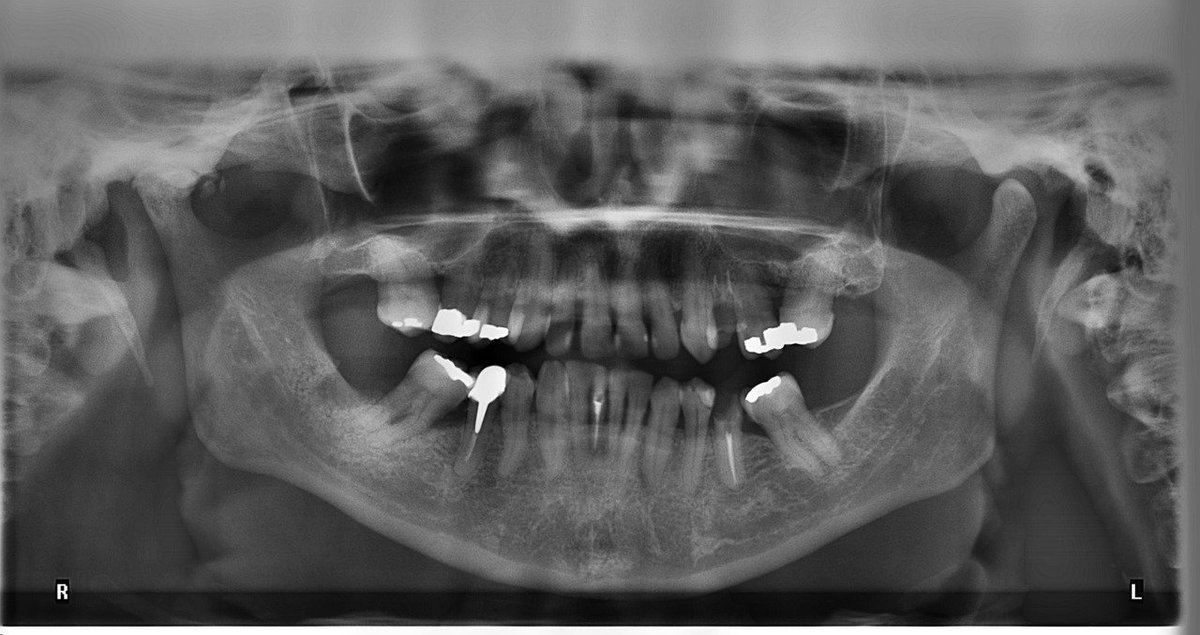 El #empaste tiene tanto fines estéticos como rehabilitantes. Si necesitas dar solución a algún tipo de #problema #bucodental ¡no dudes en pedirnos cita! Además, ¡es muy fácil con éste #formulario #online! 👉 ow.ly/RvPd30m4Nxm #Dentista #Malaga #Bucodente