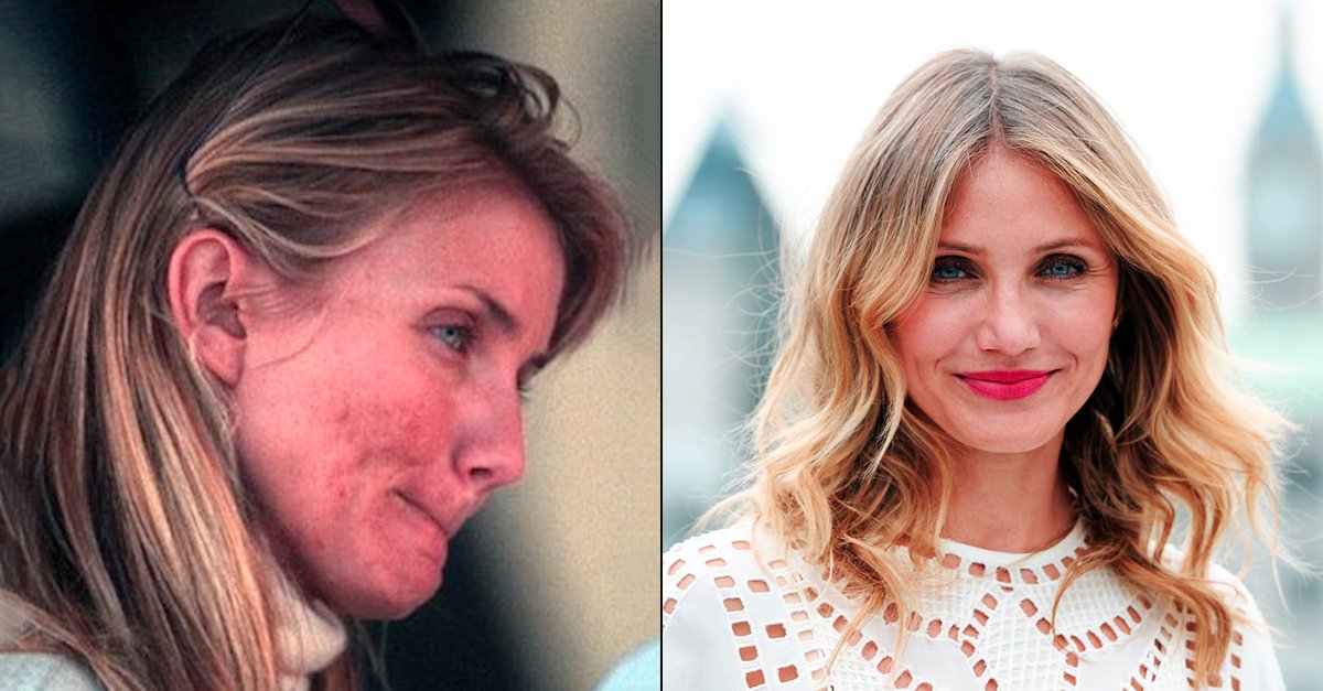 DrFulyaTezel's tweet image. Akne hepimizin hayatında en az bir kere karşılaştığı bir problem, neden tedavi alan sadece ünlüler olsun? Siz de problemsiz bir cildin hayalini kuruyorsunuz biliyoruz. 😊 #camerondiaz #aknetedavisi #sivilceproblemi #dermatoloji #akne #sivilce #ciltsağlığı #fulyatezel