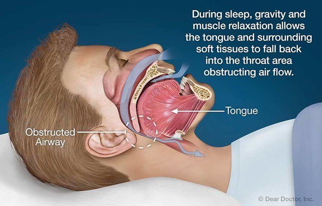 StopSnoringAus's tweet photo. What happens when you’re asleep? Find out here, https://t.co/2lBU5Db2sd 👈🌙

#GetBetterSleep #StopSnoringAustralia #sleep #snoring #health https://t.co/GpUkFVa3c6
