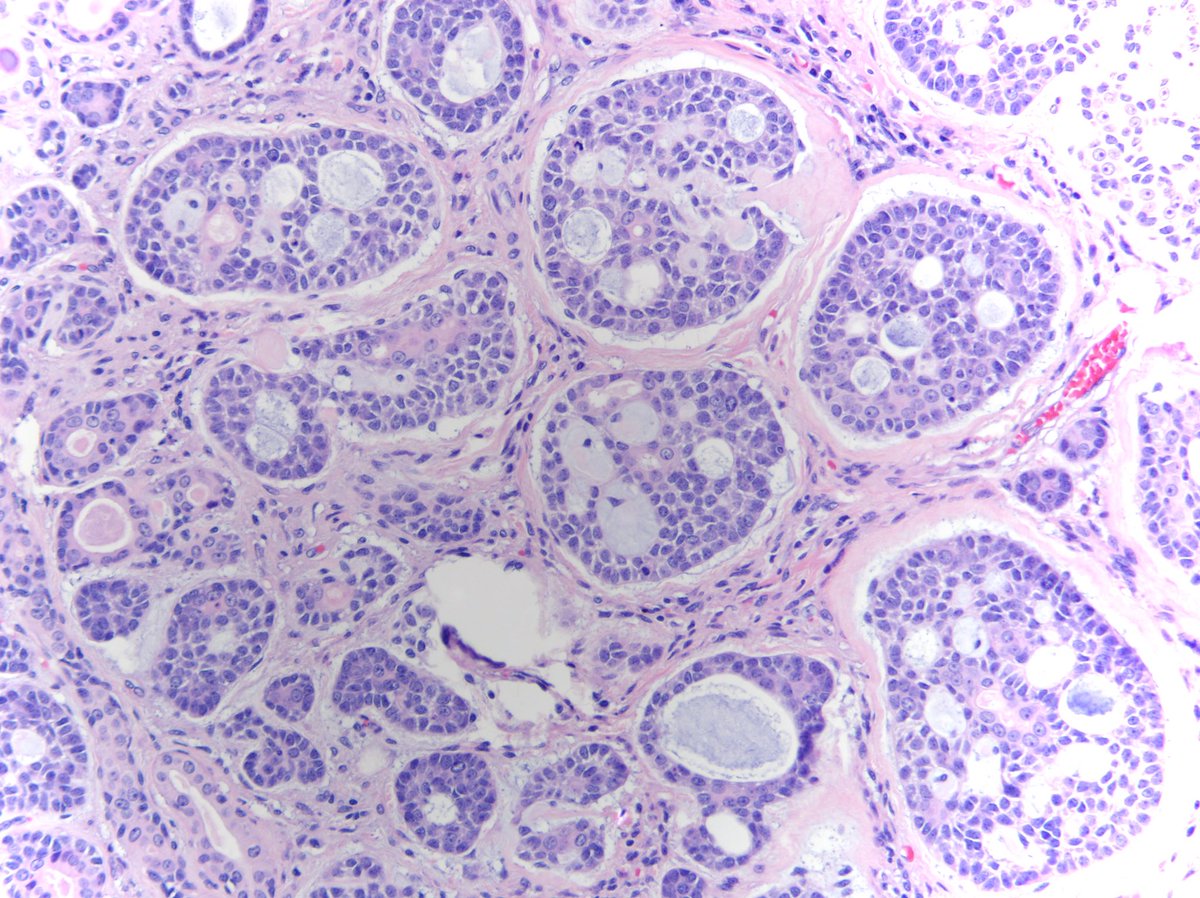 Happy Friday all! #LungPath  Adenoid cystic carcinoma!