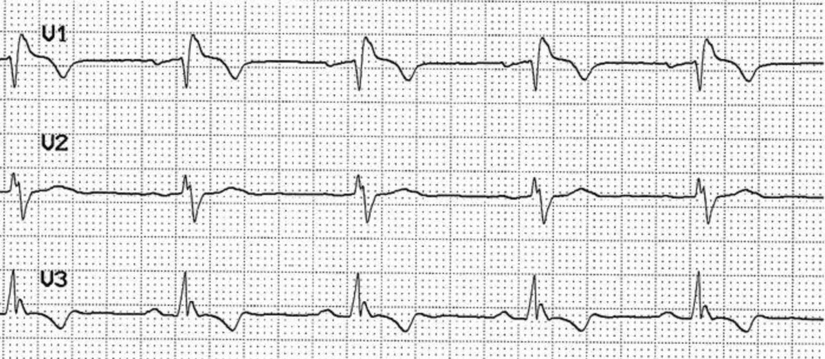 BrooksWalsh's tweet photo. "Isolated" RBBB as only sign of acute MI?
Sure is a lot of STE in V1 for a simple RBBB.
https://t.co/JY4X3QSx2b https://t.co/IL4g2HAp3D