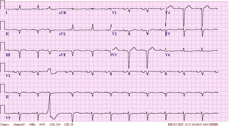 Learntheheart Com Ar Twitter Ecg Findings Sinus Rhythm Left Atrial Enlargement P Mitrale Lbbb 1st Degree Av Block Pvc Ecg Usmle Learntheheart Com Ar Twitter Ecg Findings Sinus Rhythm Left Atrial Enlargement P Mitrale Lbbb 1st Degree Av Block Pvc Ecg Usmle