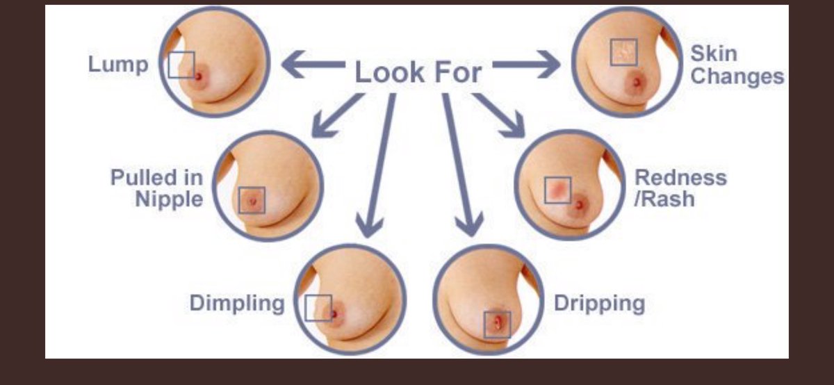 tstormmd's tweet photo. Know your breasts!  Mammograms are great, but far from perfect and breast cancer is common, 1 in 8 (1 in 6 if you include DCIS) so know the signs to watch for. Thanks @breastadvovate!  #patientchoice #breastcancersurgery #breastcancet https://t.co/qvBBwvJNeQ
