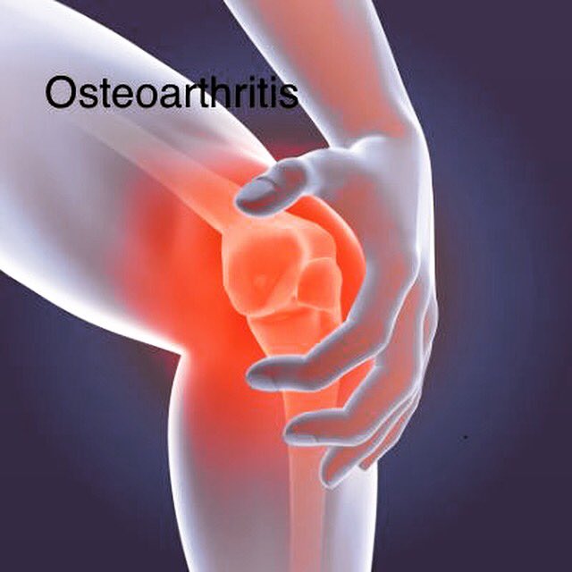ContactUpl2012's tweet image. Osteoarthritis is increasing in our inactive population. To help keep joints moving &amp;amp; managing OA KEEP MOVING at least 15mins a day  @neneliving @GoPhantoms @QueenBeePboro #OA #keepmoving #activedaily