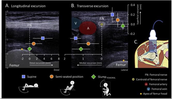 MSKPhysioJnl's tweet image. Femoral nerve excursion with knee and neck movements in supine, sitting and side-lying slump: An in vivo study using ultrasound imaging @michelcoppie Please find complimentary full text buff.ly/2TAsZeD  Please Retweet #neurodynamics #MSK