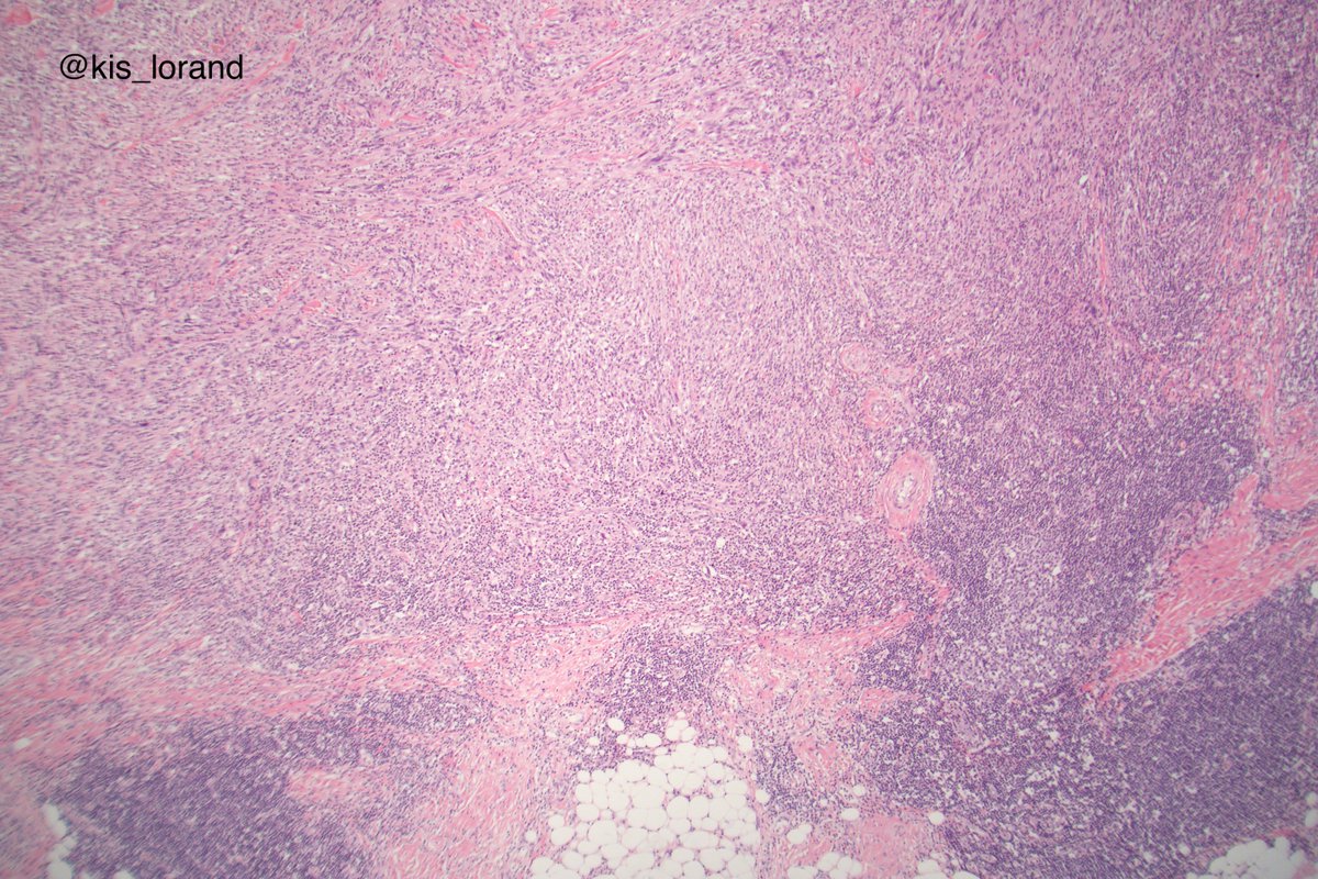 Spindle cell tumor in the dermis. Any thoughts on what it could be?  #pathology