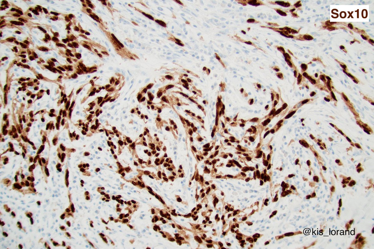 Spindle cell tumor in the dermis. Any thoughts on what it could be?  #pathology