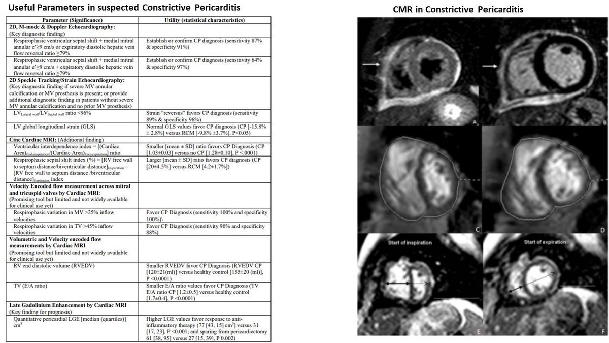 Do u know ur Noninvasive Multimodality Imaging for the Dx of Constrictive Pericarditis?@CircAHA @CircImaging ahajournals.org/doi/full/10.11…
Great work from Wissam Alajaji @AllanLKleinMD1 and our team at @CleClinicMD #ACCFIT #Cardiotwitter @emory_heart #ACCImaging. @iamritu @CoronaryDoc