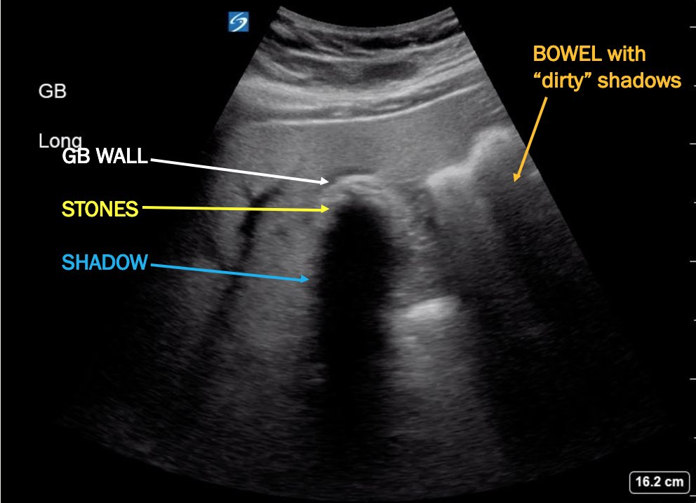 Wall-echo-shadow sign (ultrasound), Radiology Reference Article