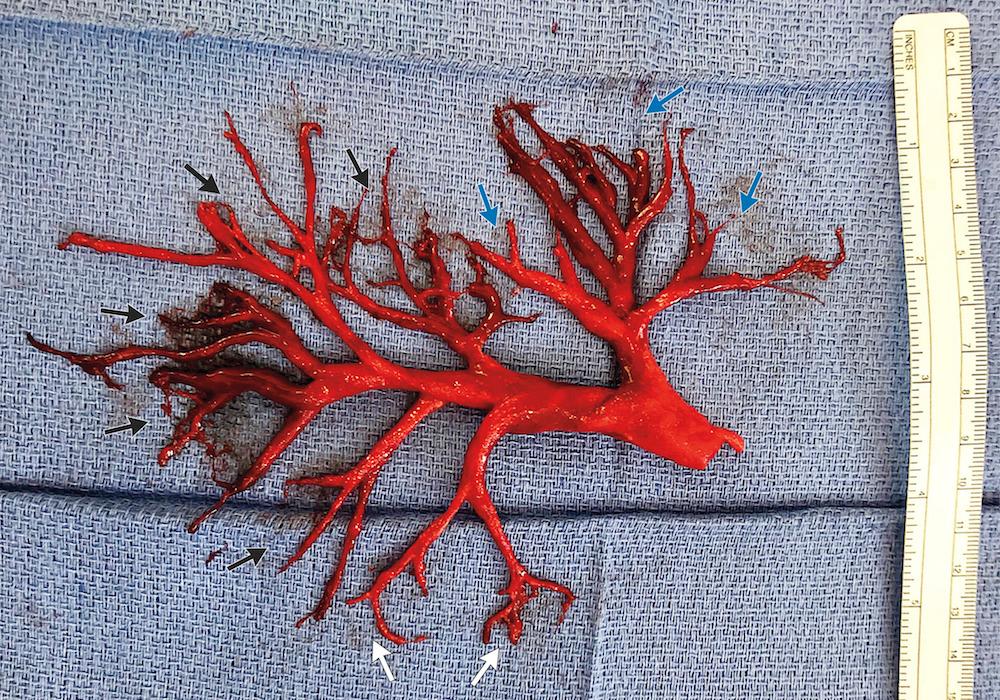 OttawaCitizen's tweet photo. A patient coughed up this huge blood clot that perfectly replicates the airways of his lung  https://t.co/ulADocMKkt https://t.co/X2yQpa3DyS