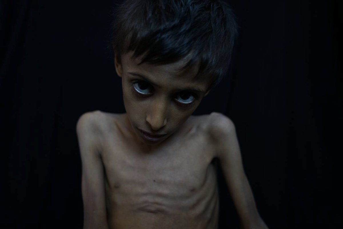 My Sunday column is from Yemen where 85,000 kids are already dead, not from drought but from Saudi/UAE/US policy. The Saudis try to keep reporters from Yemen because they don't want you to see images like these. Our tax dollars are going to starve kids. https://nyti.ms/2G5fkK4