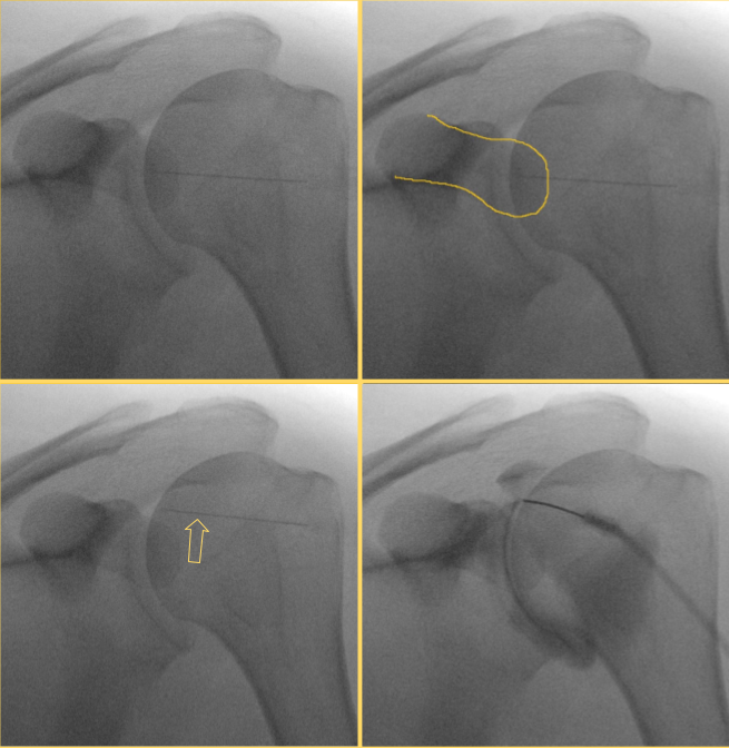 MSKfellowship's tweet photo. Pro tip: watch out for a prominent coracoid process when injecting shoulders. 

If you line up your needle and see it overlying a prominent coracoid (outlined in gold), then move your needle above the coracoid (arrow) and proceed with the injection.

#MSKrad https://t.co/SIHhNRj8tu