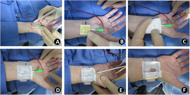 CRMjournal's tweet photo. Article in press: Comparison of #hemostasis times with a chitosan-based hemostatic pad (Clo-SurPlus radialโข) vs. mechanical compression (TR bandยฎ) following #TransradialAccess: A pilot study by Jonathan S. Roberts et al. https://t.co/9kgYJIVAt6 https://t.co/UBjzMb0Pza